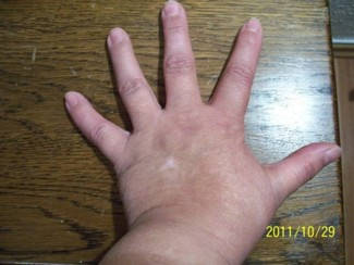 Törpanyó - bal kézfej